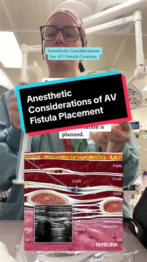 Anesthetic options for AVF creation include regional anesthesia (brachial plexus block), local anesthesia, and general anesthesia, with regional blocks offering superior outcomes in some studies. #anesthesiology #medicine #dialysis #medicaleducation #learnwithme DISCLAIMERS: This video is intended for educational purposes only. It does not contain medical advice. This video was filmed prior to patient care activities beginning for the day. There are no patients in this video, nor are there any n