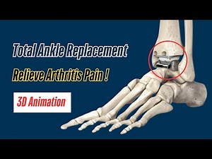 Total Ankle Replacement Surgery (Ankle Arthroplasty) | Treatment for Severe Ankle Arthritis