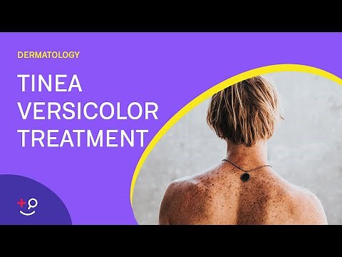 How To Treat Tinea Versicolor?