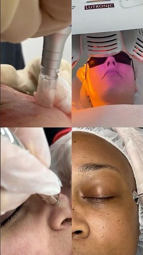 Skin Resurfacing Treatment for Acne Scarring & Scarring | Results Laser Clinic #acnescars #scars