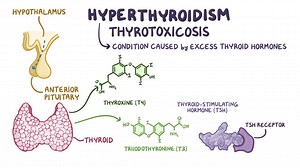 Video: Hyperthyroidism: Clinical - Video Explanation! | Osmosis | Osmosis