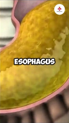 Acid Reflux Simplified #GERD #AcidReflux #DigestiveHealth