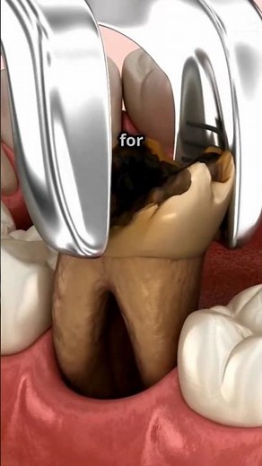 Tooth Extraction Explained 🦷 #facts