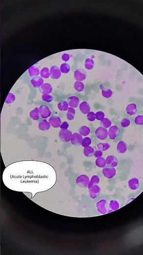 ALL~Bone marrow smear👀🔬Lots of blast cells🤗