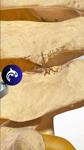 When Nerves Get Trapped: Foraminal Stenosis in 3D