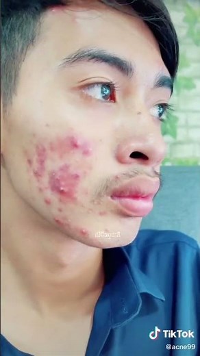 Satisfying With Loan Nguyen Spa Video #acnetreatment