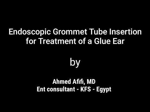 Endoscopic grommet tube insertion for treatment of a glue ear. Afifi, MD