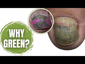 Green Toenail Transformation | Bacteria & Fungus Cleanup