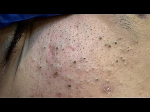 The Ultimate Facial Care Routine Blackheads Removal & Pimple Treatment