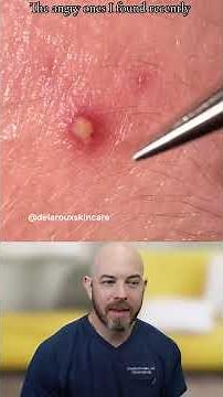 Inflamed Cyst Extraction: Why Tool Choice Matters
