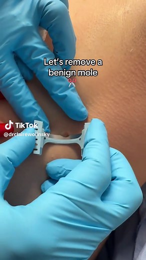 Satisfying 🤤 #dermatology #skin #doctor | mole