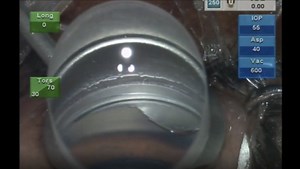 Mission Impossible - MIGS for the Developing World - Eyetube