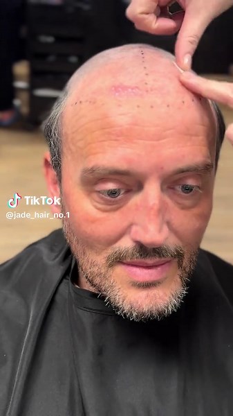 Hair Replacement System with Gentle Facelift Effect