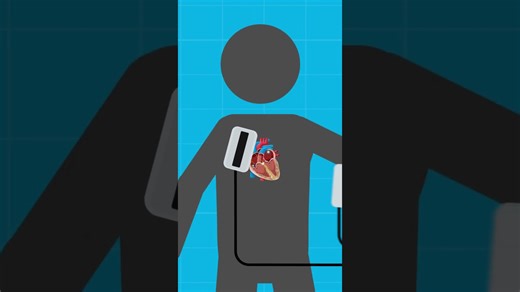 See how a defibrillator affects your heart during real treatment