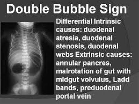 Double bubble Feature for X ray; Definition, Clinical Significance