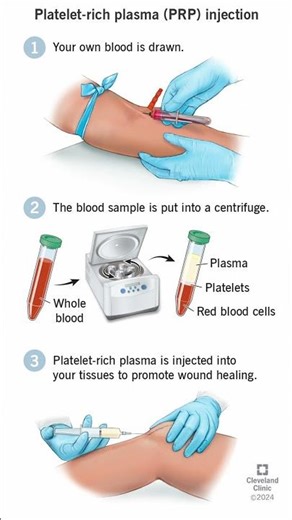 Role of Plate Rich Plasma -PRP in Rheumatic conditions ,is it magic bullet ?