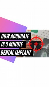 142K views · 3.4K reactions | HOW ACCURATE IS 5 MINUTE DENTAL IMPLANT...