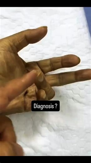 RK NURSE'S HUB on Instagram: "Dupuytren's contracture (also called Dupuytren's disease) is a progressive hand condition where the tissue under the skin of the palm—the palmar fascia—thickens and tightens. This creates tough, rope-like cords that pull one or more fingers into a permanently bent position toward the palm, making it impossible to straighten them. Core Symptoms and Progression The condition usually develops slowly over several years. Nodules: It typically begins as small, firm, and o