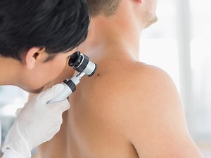 Compound Blocks Melanoma Metastasis by 90 Percent | Cancer