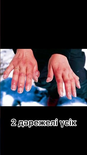 What to do when you get frostbite?