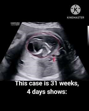 Fetus in fetu on ultrasound #ultrasound #pregnant