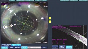 Using Astigmatic Keratotomy with LenSx for Laser Assisted Cataract Surgery with a Toric IOL - Eyetube