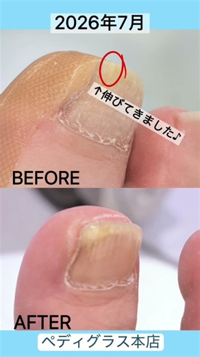 【巻き爪】縦に割れた爪がここまで改善！