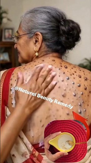 Remove warts permanently at home naturally🌿Safe• Easy• EffectiveTry this simple remedy today!#warts