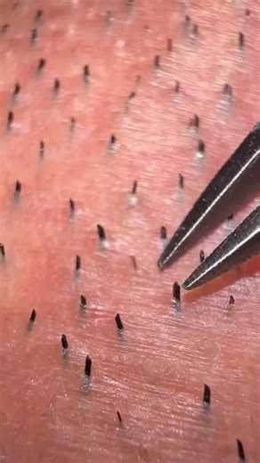 Tired of stubborn mustache hair? 😩 Watch this simple tweezers trick to get smooth, silky skin in seconds! #MustacheRemoval #HowTo #SkincareRoutine #FacialCare #BeautyTips | April-09-04
