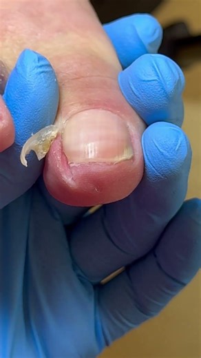 Silky Smooth Cut Away Ingrown Nails ~ Decompression #nails #satisfying