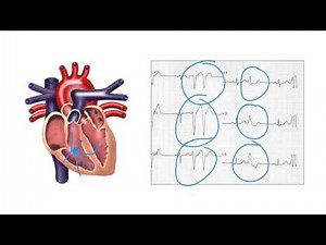Determining the Origin of Ventricular Ectopic Beats • Video • MEDtube.net