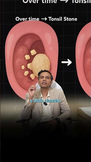 ⚠️ Those White Chunks in Your Throat? They Could Be Tonsil Stones! #apollohospitals#throatcare