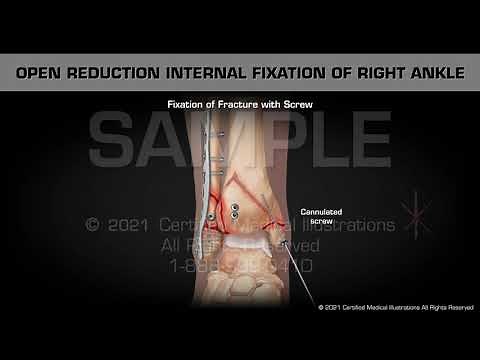 Open Reduction Internal Fixation of Right Ankle