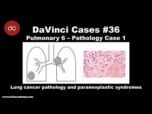 Lung Cancer and Paraneoplastic Syndromes Case [#DaVinciCases Pulmonary 6 - Pathology Case 1]