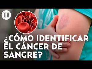 ¿Moretones en la piel sin razón aparente? Así puedes saber si se trata de cáncer de sangre