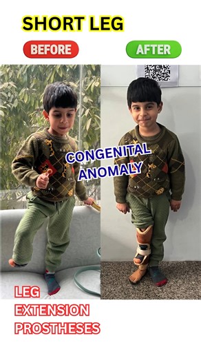 🔔 Subscribe for more videos on orthotics, rehabilitation & post-operative care. 📞 Call Now: 98739 84995 📍 Visit Us: B-24, 2nd Floor, Lajpat Nagar Part-2, Delhi 🚇 Walking distance from Metro Gate-1, Opp. Metro Pillar No. 9 🌐 Website: https://www.iasgroups.in 📍 Get Directions: https://maps.app.goo.gl/sGQjMRqg3y6cEGsD7 🔔 Subscribe for prosthetic education & success stories 📸 Instagram: https://instagram.com/idealartificiallimbssolutions 💼 LinkedIn: https://linkedin.com/in/idealartificialli