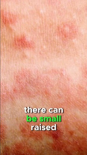 Measles rash explained | #health #measles #doctor #MMR #vaccine #publichealth