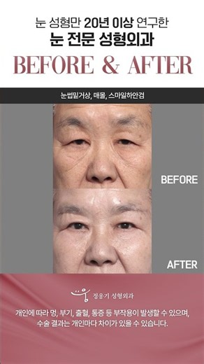고급스러운 동안 눈매의 완성, 눈수술 전후 비교! #압구정역성형외과 #압구정눈썹거상 #신사역하안검 #눈성형