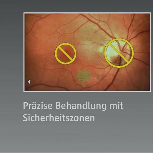 Navilas® - Der Einstieg in die navigierte Lasertherapie der Netzhaut