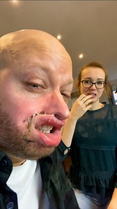 Swollen lips prank backfires badly 😳 | Neil Henry