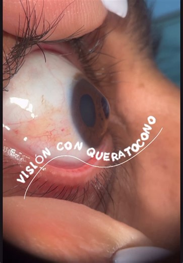 La visión en un paciente con queratocono es tan distorsionada debido a un cambio fundamental en la geometría de la córnea que altera por completo cómo entra la luz al ojo. Para moldear dicha superficie es necesario un lente rígido que modifique las medidas de la córnea, a las medidas de una córnea sana y así el paciente experimente una visión nítida. La córnea es una de las partes del cuerpo con más terminaciones nerviosas, los lentes rígidos de apoyo corneal de diámetros pequeños, suelen movers