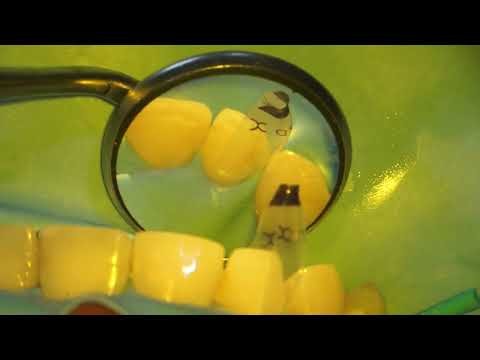 Bioclear TSS Matrix to Correct a Lateral Incisor