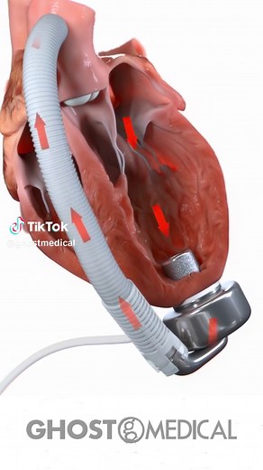 Revolutionizing Heart Care: The LVAD Animation