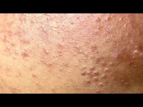 OMG! 😱 Most Satisfying Deep Pore Extraction #1098 | Relaxing Skin Care Therapy | PurePore Spa