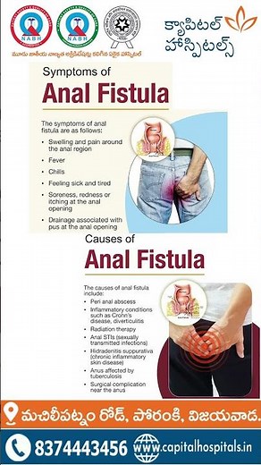 Anal Fistula | Symptoms, Causes & Advanced Treatment | Capital Hospitals