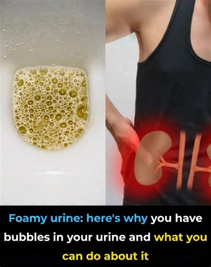 Foamy Urine: Here’s Why You Have Bubbles in Your Urine | Blogtamsu