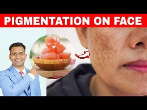 How To Remove Pigmentation On Face at Home Naturally - Dr. Vivek Joshi
