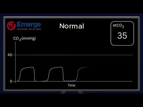 Waveform Capnography - Normal Waveform