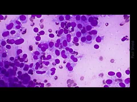 Thyroid FNA Cytology - Unknown Case 1