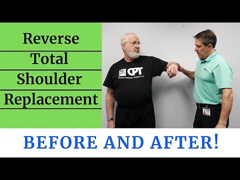 Reverse Total Shoulder Replacement Before & After